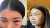 Mantakarn Seenin, A Thai woman shows her wounds on her face caused by brutally attacked while riding the BART train in San Francisco, CA.