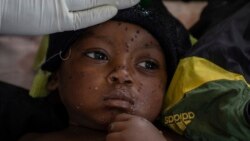 SML: Bopesi mangwele ma mpox bozali kobanda na Goma mpe na Bukavu