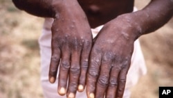 Paciente vítima dao virus mpox durante um surto na RDC em 1997 (arquivo)