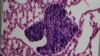 Belgian Researchers Discover Way to Block Cancer Metastasis
