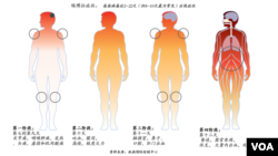 伊波拉症狀